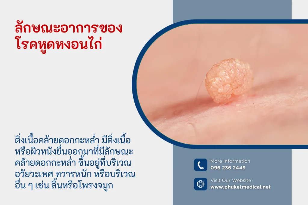 ลักษณะอาการของโรคหูดหงอนไก่
