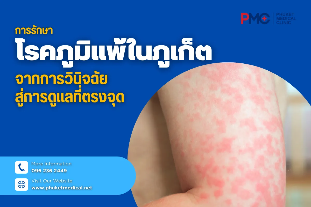 การรักษาโรคภูมิแพ้ในภูเก็ต จากการวินิจฉัยสู่การดูแลที่ตรงจุด