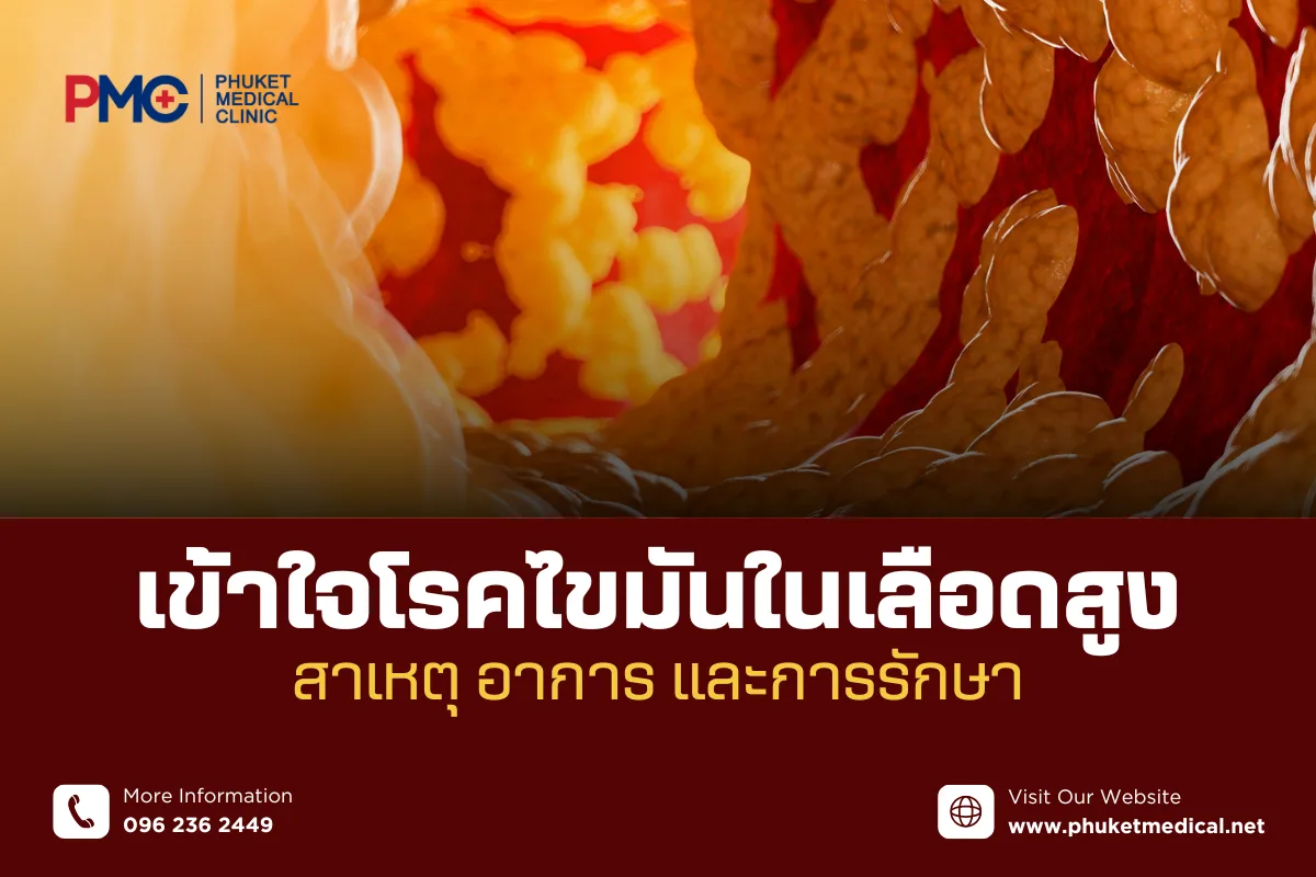 เข้าใจโรคไขมันในเลือดสูงสาเหตุ อาการ และการรักษา