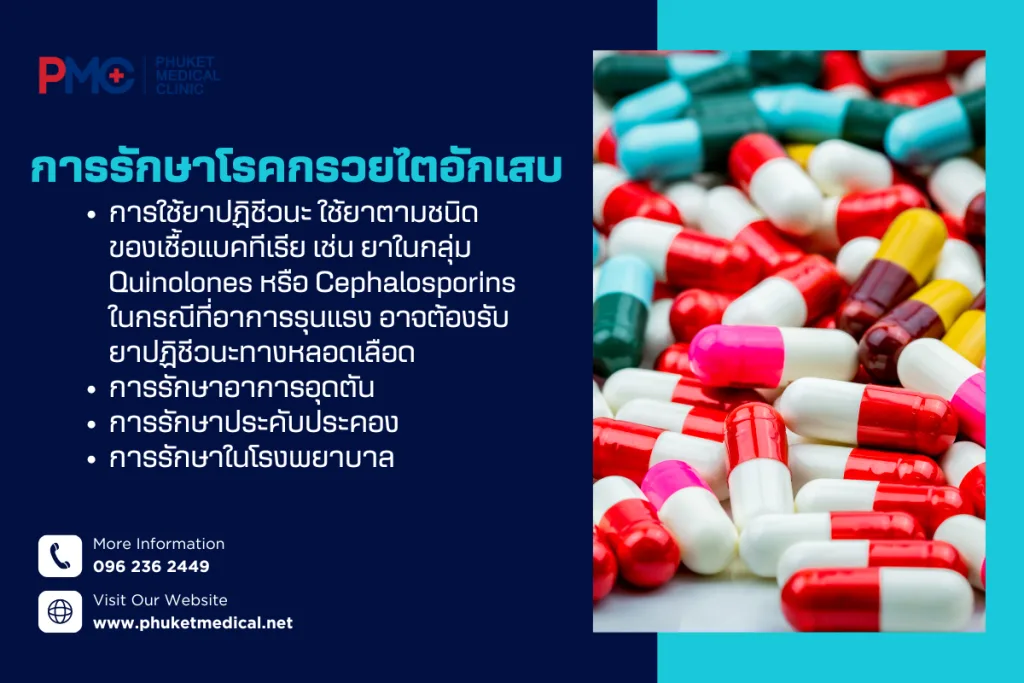 การรักษา โรคกรวยไตอักเสบ