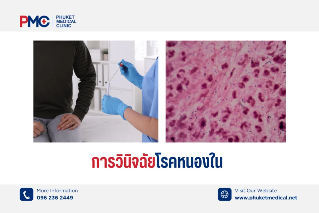 การวินิจฉัยโรคหนองใน