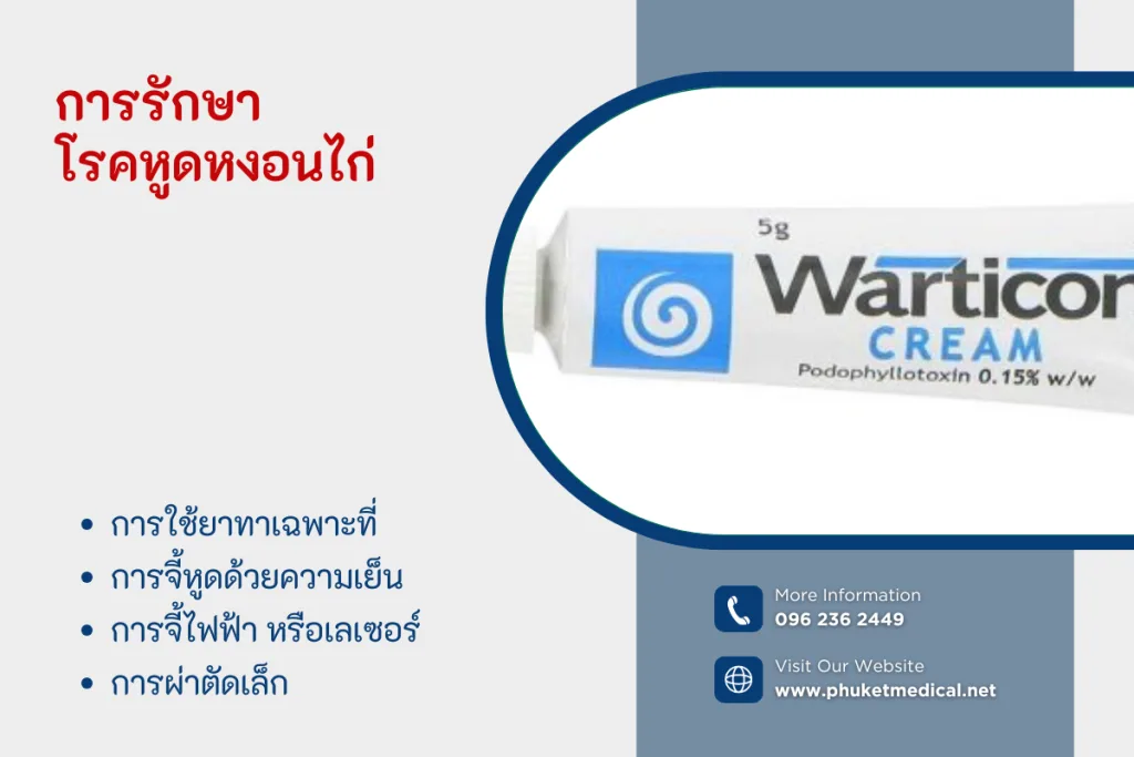 การรักษาโรคหูดหงอนไก่
