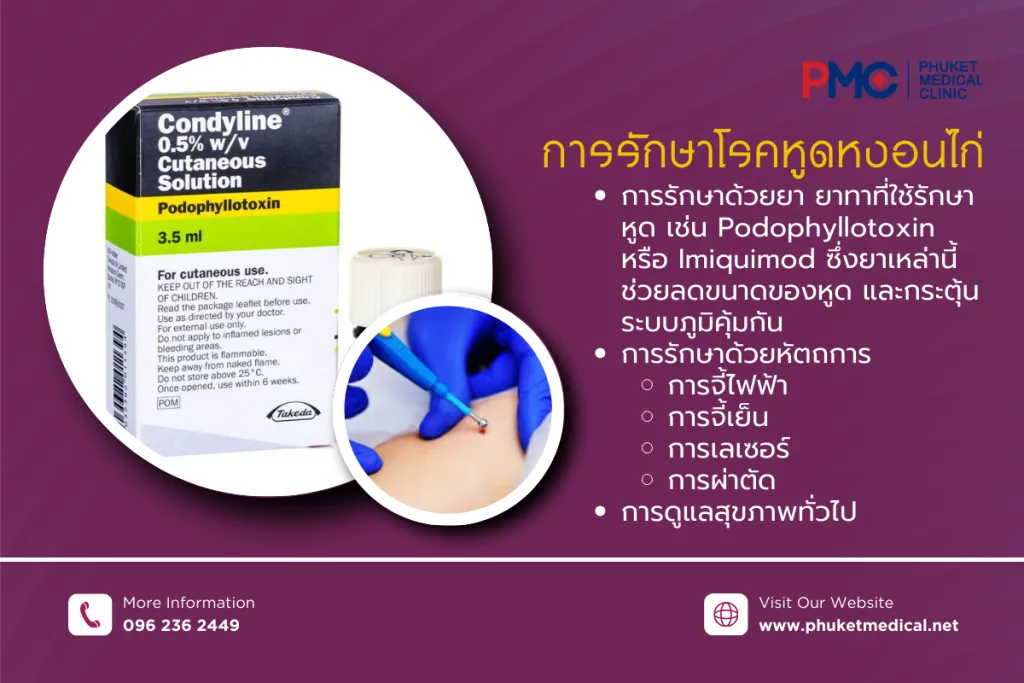 การรักษา โรคหูดหงอนไก่