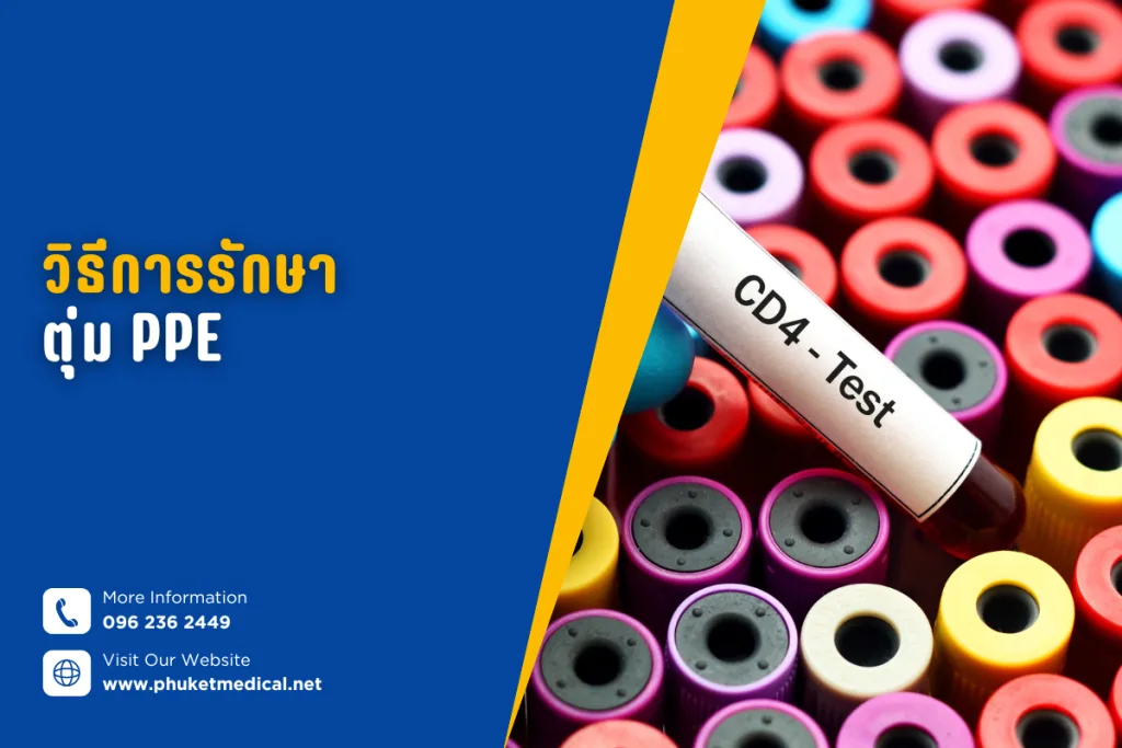 วิธีการรักษาตุ่มPPE