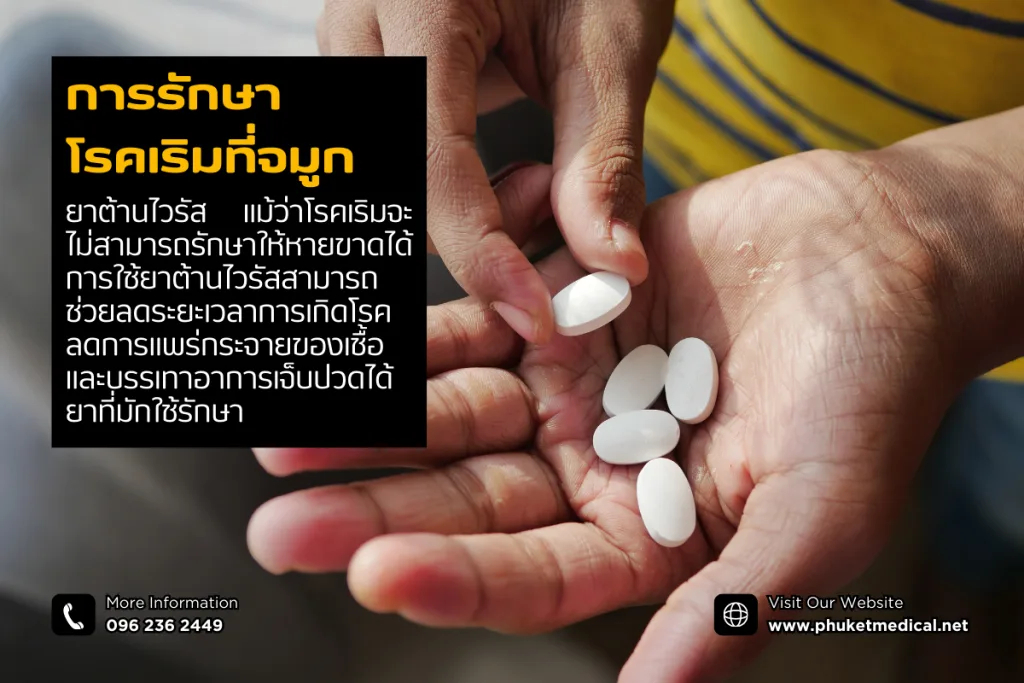 การรักษาโรคเริมที่จมูก