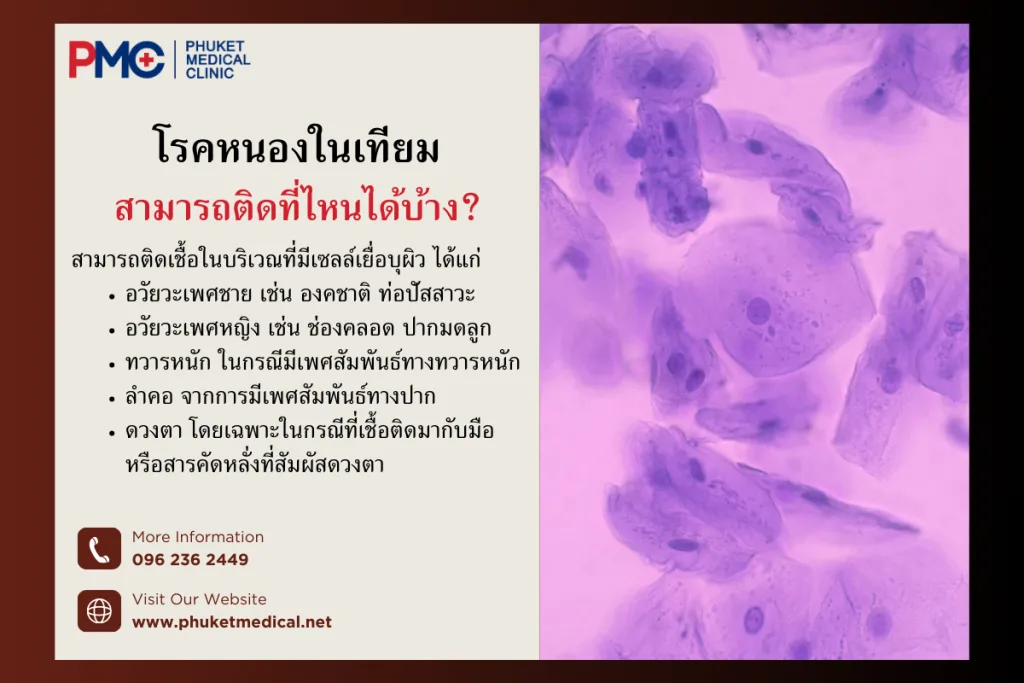 Chlamydia Trachomatis
