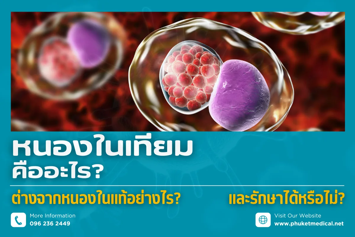หนองในเทียมคืออะไร ต่างจากหนองในแท้อย่างไร และรักษาได้หรือไม่