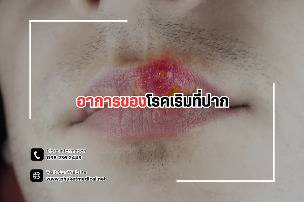 อาการของโรคเริมที่ปาก
