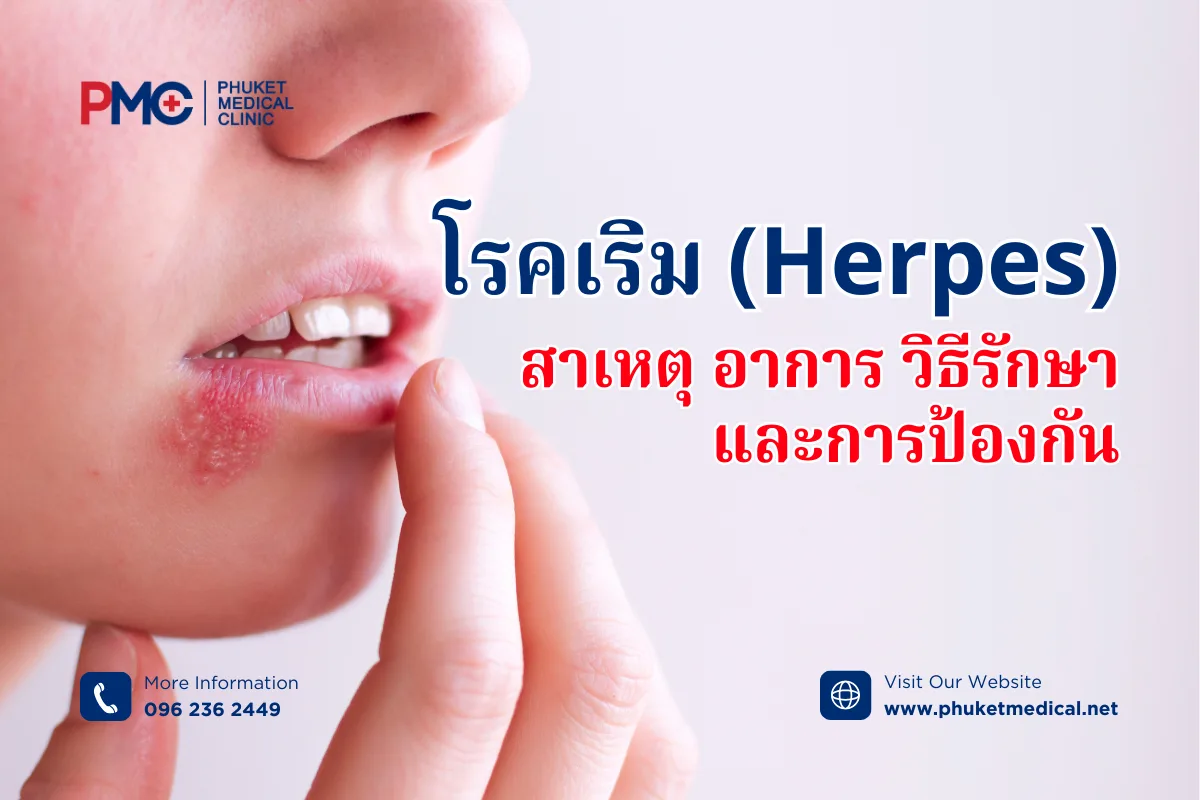 โรคเริม (Herpes) สาเหตุ อาการ วิธีรักษา และการป้องกัน