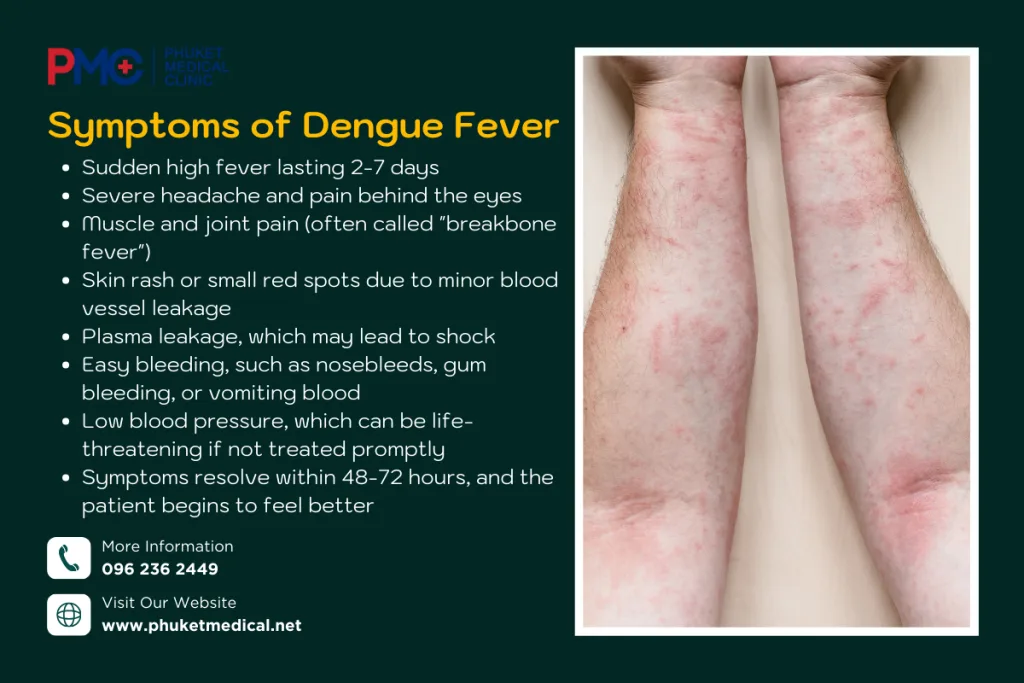 Symptoms of Dengue Fever