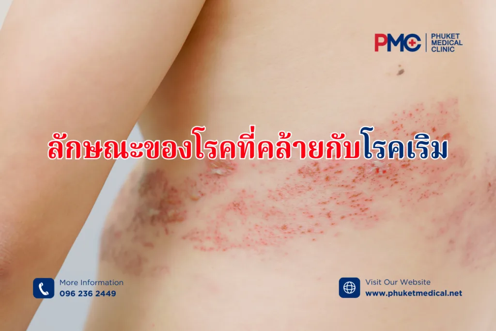 ลักษณะของโรคที่คล้ายกับโรคเริม