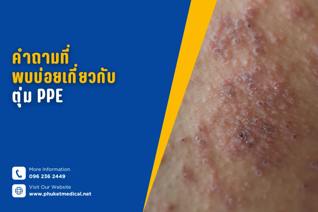 คำถามที่พบบ่อยเกี่ยวกับตุ่มPPE