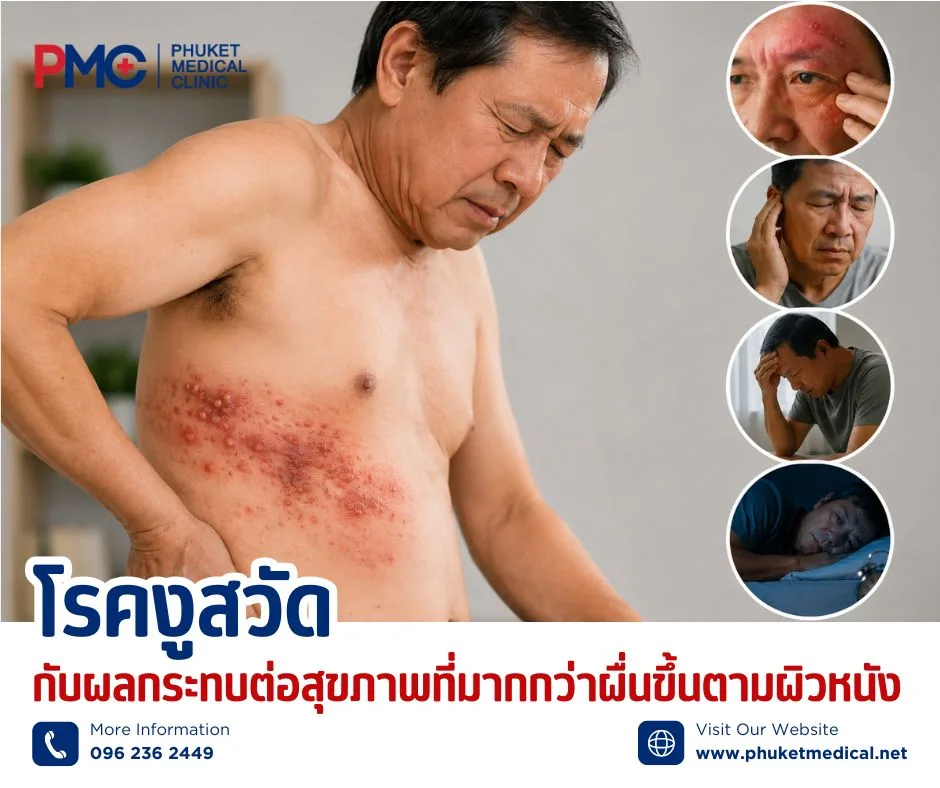 โรคงูสวัดกับผลกระทบต่อสุขภาพที่มากกว่าผื่นขึ้นตามผิวหนัง