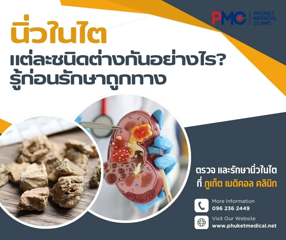 นิ่วในไตแต่ละชนิดต่างกันอย่างไร? รู้ก่อนรักษาถูกทาง