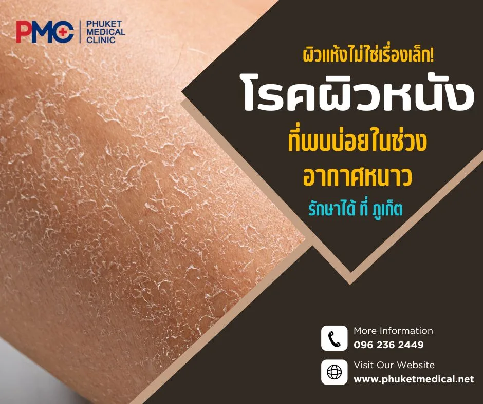 ผิวแห้งไม่ใช่เรื่องเล็ก! โรคผิวหนังที่พบบ่อยในช่วงอากาศหนาว รักษาได้ที่ภูเก็ต