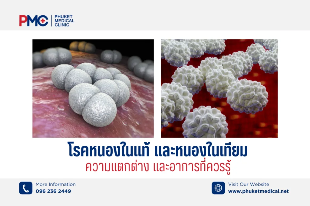 Gonorrhea infection