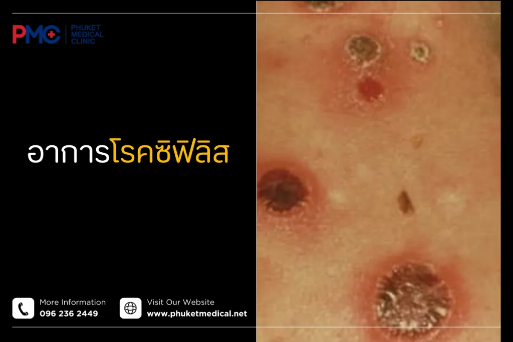 Syphilis infection