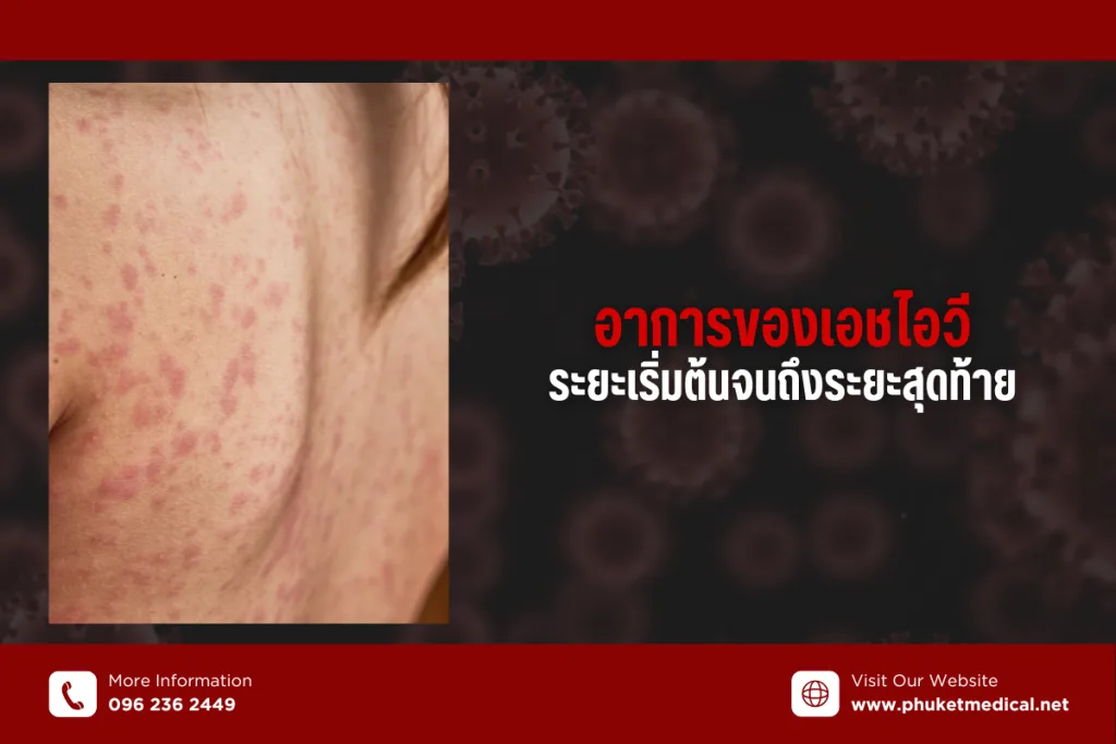 อาการของเอชไอวี ระยะเริ่มต้นจนถึงระยะสุดท้าย