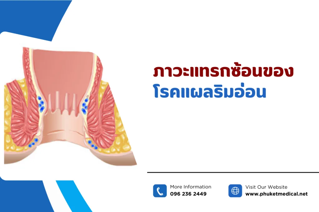 ภาวะแทรกซ้อนของโรคแผลริมอ่อน