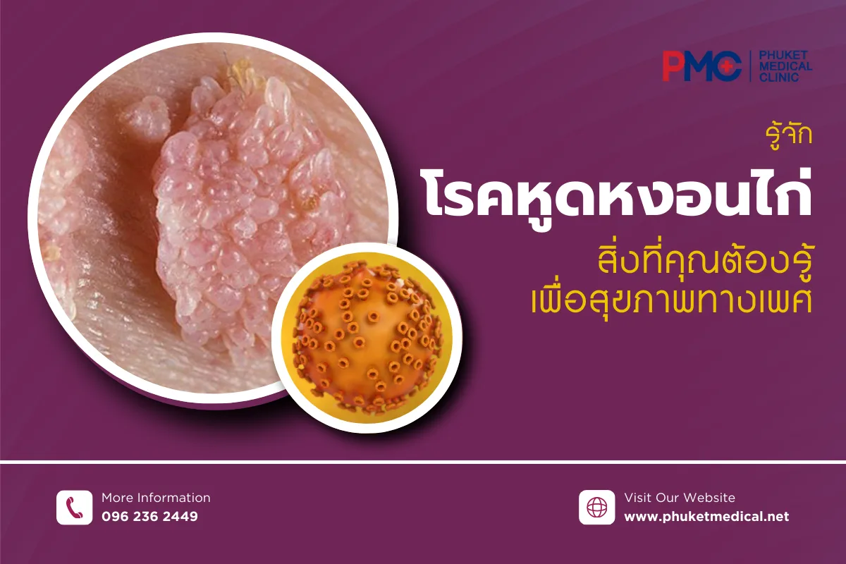 รู้จักโรคหูดหงอนไก่ สิ่งที่คุณต้องรู้เพื่อสุขภาพทางเพศ