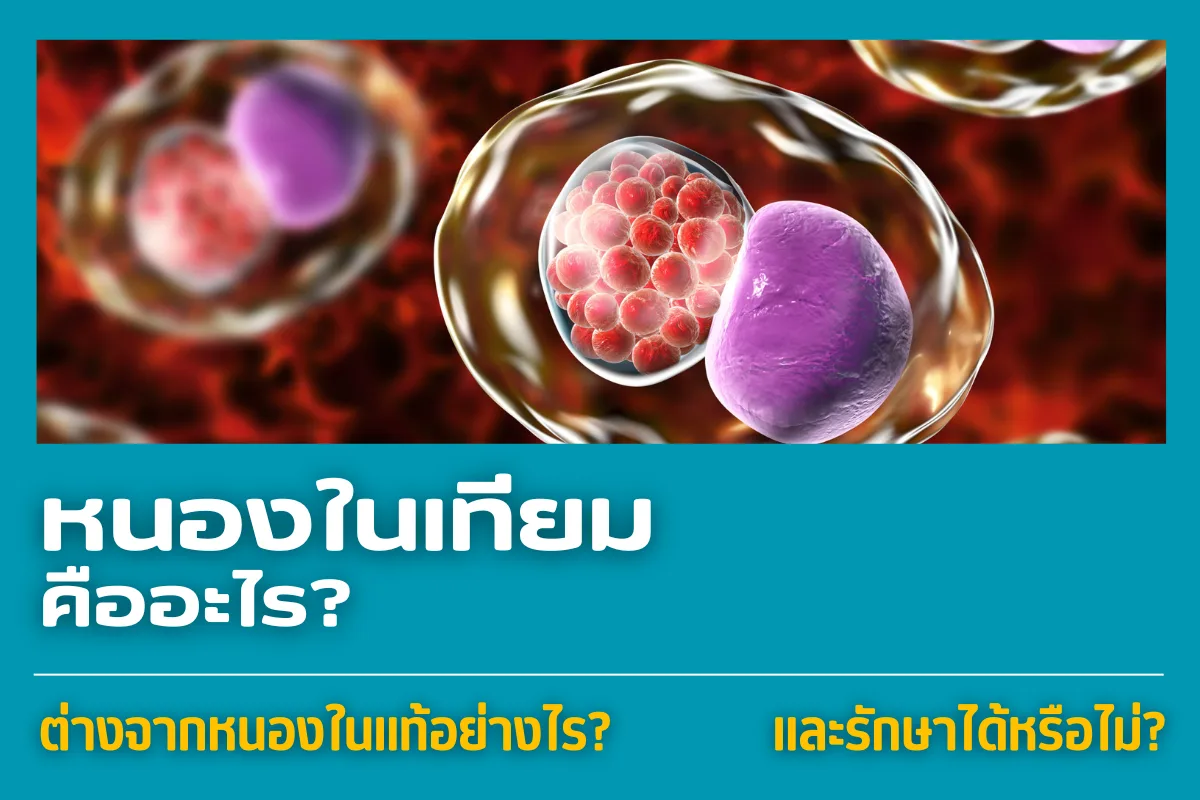 non-gonococcal urethritis