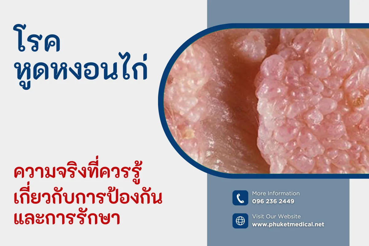 โรคหูดหงอนไก่ ความจริงที่ควรรู้เกี่ยวกับการป้องกัน และการรักษา