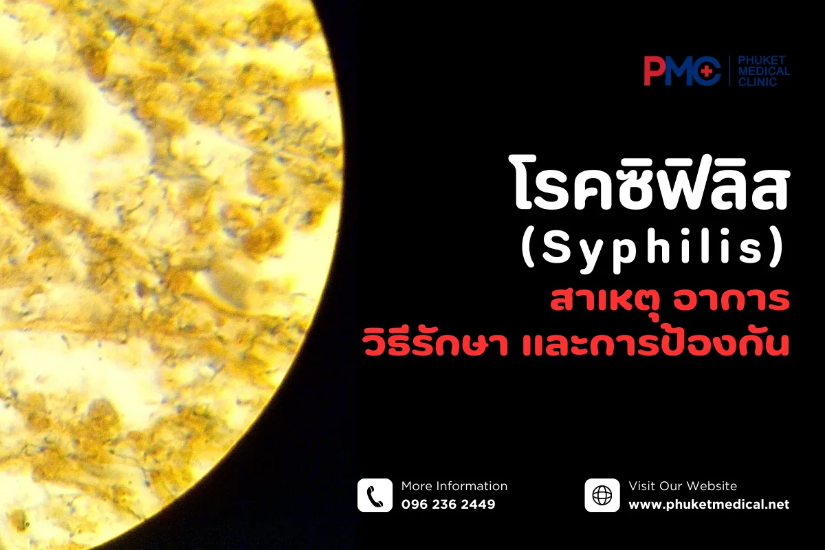 โรคซิฟิลิส (Syphilis) สาเหตุ อาการ วิธีรักษา และการป้องกัน
