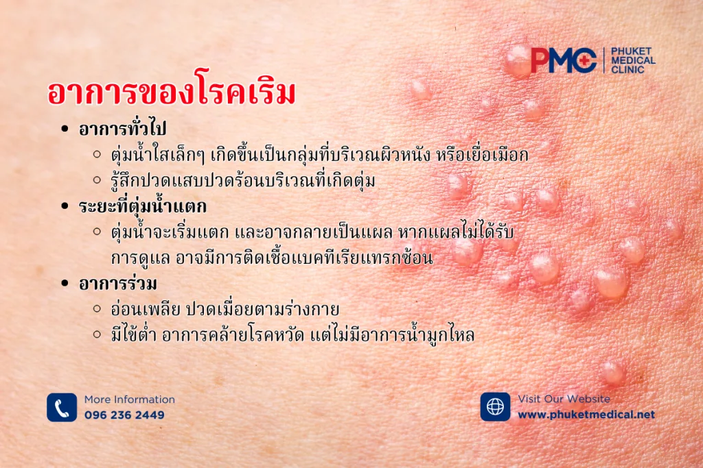 อาการของโรคเริม