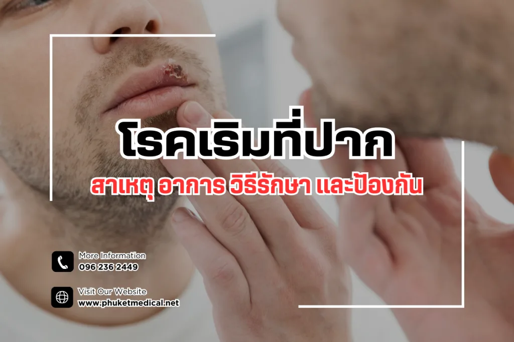Oral herpes