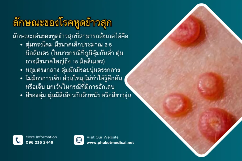 Molluscum contagiosum