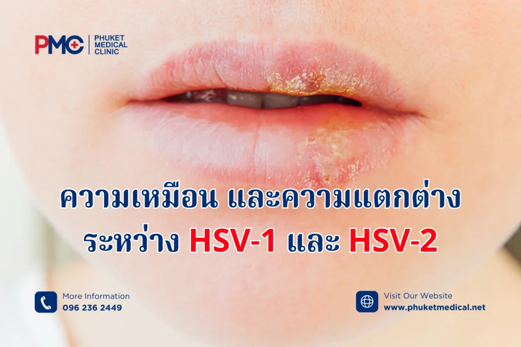 Herpes